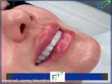 فیلم قرار دادن لامینیت سرامیکی بر روی دندان ها
