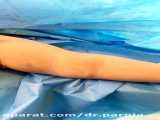 براکیوپلاستی(جراحی زیبایی بازو)