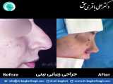 نمونه قبل و بعد از جراحی زیبایی بینی | دکتر باقری حق