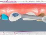 لمینت سرامیکی | کلینیک تخصصی دندانپزشکی کانسپتا