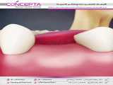 ایمپلنت دندان | کلینیک تخصصی دندانپزشکی کانسپتا