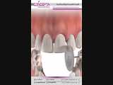 مثلث سیاه بین دندان ها | کلینیک تخصصی دندانپزشکی کانسپتا 