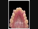 فیلم نمایشی از حرکت دندان ها در طول ارتودنسی  | دکتر سعید قریشی 