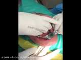 جراحی یک واحد ایمپلنت فک پایین دندان