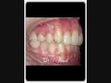 درمان ارتودنسی بدون کشیدن دندان | دکتر سعید قریشی 
