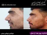 نمونه قبل و بعد از عمل جراحی زیبایی بینی
