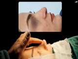 نمونه جراحی زیبایی بینی توسط دکتر نیلوفر تاری