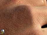 روش های درمان خشکی پوست در بیماری پسوریازیس که میتواند مفید باشد