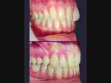درمان ارتودنسی ثابت دو فک همراه با کشیدن یک دندان | دکتر سپیده دادگر 