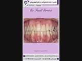 ترکیبی از درمان ارتودنسی ثابت و درمان دندانپزشکی زیبایی و ترمیمی | دکتر فاضل فیروزی 
