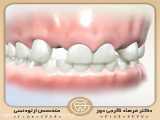 درمان ارتودنسی به همراه ایمپلنت دندان | دکتر فرهاد گرجی دوز