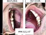 عکس های قبل و بعد از کامپوزیت و ایمپلنت دندان