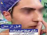 نمونه ای از جراحی زیبایی بینی مردانه