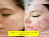 درمان افتادگی پوست و لیفتینگ صورت و بدن (رفع چین و چروک)