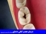 پالپ (بافت داخل دندان) | دکتر احسان ابوئی مهریزی