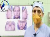 فیلم جراحی رینوپلاستی در بینی های گوشتی