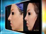 تغییر محسوس در چهره پس از جراحی زیبایی بینی