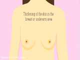 آموزش خود آزمایی سرطان پستان در بانوان