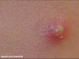 ویروس پاپیلوما انسانی HPV