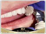 پالیش دندان های کامپوزیت شده | دکتر لیلا عطایی