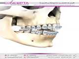 درمان اپن بایت با جراحی فک | کلینیک تخصصی دندانپزشکی کانسپتا