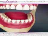 جراحی دندان عقل نهفته | کلینیک تخصصی دندانپزشکی کانسپتا