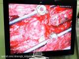نورومانیتورینگ عمل جراحی T12 Osteoporosis Fracture_Revision