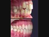 درمان ارتودنسی ثابت دو فک بدون کشیدن دندان | دکتر سپیده دادگر 