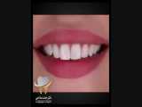 اصلاح طرح لبخند با اجرای 10 واحد کامپوزیت نانوسرامیک فک بالا | دکتر حامد صالحی 