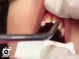 فلوراید تراپی کودکان | دندانپزشکی اطفال | دندانپزشکی در تهرانپارس
