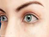 ورم ملتحمه‌ی چشم (Conjunctivitis)