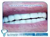 کامپوزیت دندان - دکتر شهریار الیاهو