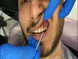 کامپوزیت ونیر دندان برای بیماری که یک یا دو دندان ندارد