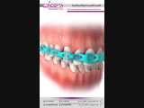 پاورچین | کلینیک تخصصی دندانپزشکی کانسپتا 