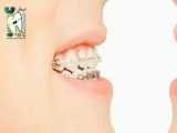 چه روش هایی برای کمتر دیده شدن دستگاه‌های ارتودنسی وجود دارد؟ | کلینیک دندانپزشکی ایده آل 