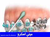 مینی اسکرو | دکتر احسان ابوئی مهریزی