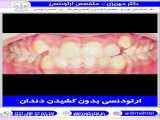 ارتودنسی بدون کشیدن دندان | دکتر احسان ابوئی مهریزی