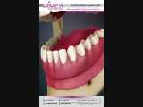 اوردنچر (پروتز بر پایه ایمپلنت) | کلینیک تخصصی دندانپزشکی کانسپتا 