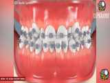 ارتودنسی چگونه باعث مرتب شدن دندان ها میشود؟