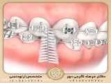مسواک بین دندانی ارتودنسی | دکتر فرهاد گرجی دوز