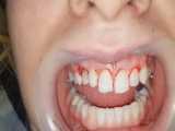درمان کامپوزیت دندان + لیفت لثه + دندان شیری