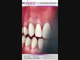 جایگزین های دندان از دست رفته | کلینیک تخصصی دندانپزشکی کانسپتا 