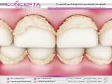 درمان پریودنتال (بیماری پیشرفته لثه) | کلینیک تخصصی دندانپزشکی کانسپتا