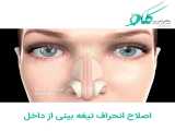 اصلاح انحراف تیغه بینی از داخل | دکتر کلکو