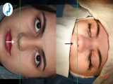 جراحی زیبایی بینی توسط دکتر محمد گلی ، متخصص گوش و حلق و بینی 