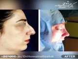 قبل و بعد از جراحی زیبایی بینی | جراح بینی تبریز