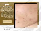 پکیج درمان جوش