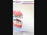 ابزار فانکشنال تاندم | کلینیک تخصصی دندانپزشکی کانسپتا 