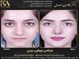 نمونه جراحی بینی