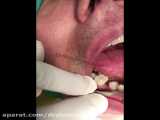 رضایتمندی بیمار عزیز از ایمپلنت دندان